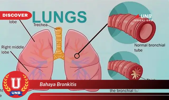 bahaya bronkitis