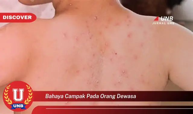 bahaya campak pada orang dewasa