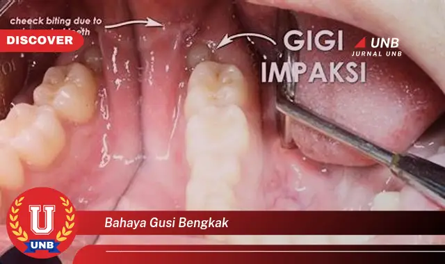 bahaya gusi bengkak