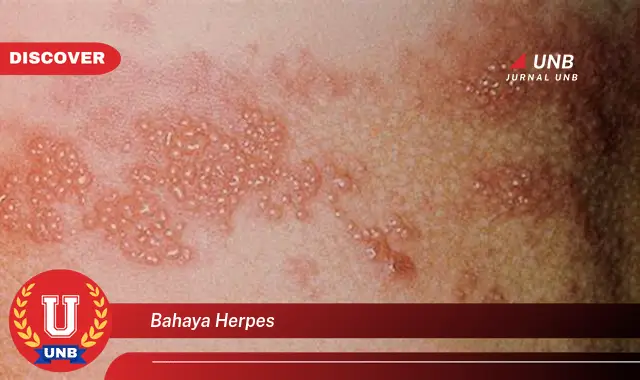 bahaya herpes