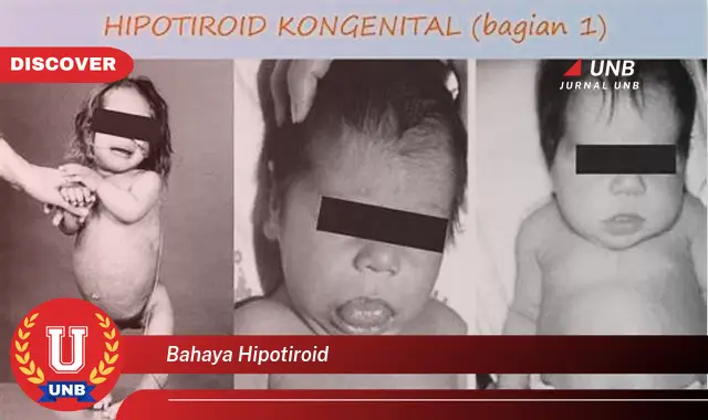 bahaya hipotiroid