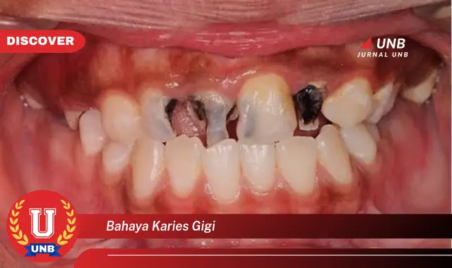 bahaya karies gigi
