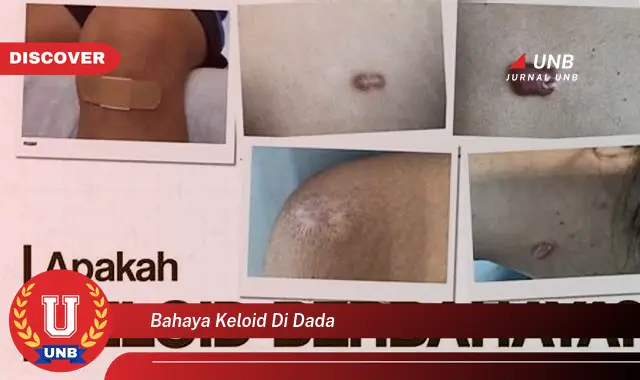 bahaya keloid di dada