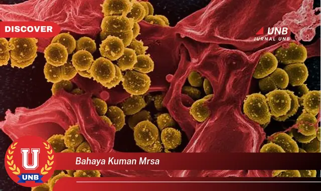 bahaya kuman mrsa bahaya kuman mrsa