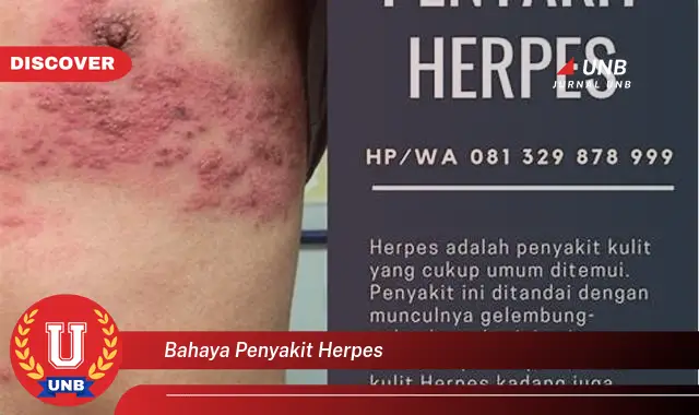 bahaya penyakit herpes