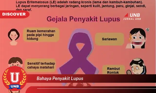 bahaya penyakit lupus bahaya penyakit lupus