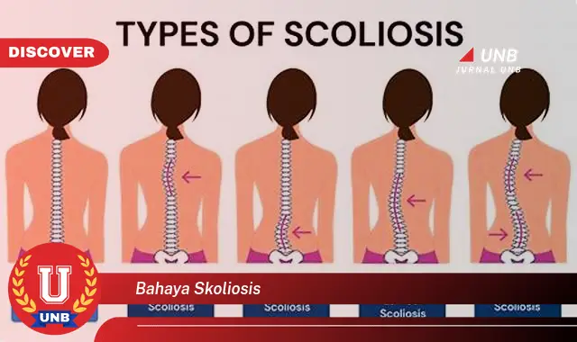 bahaya skoliosis
