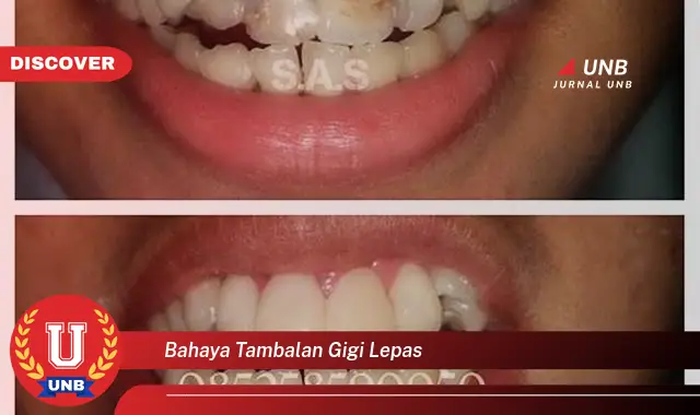 bahaya tambalan gigi lepas bahaya tambalan gigi lepas