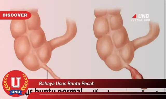 bahaya usus buntu pecah bahaya usus buntu pecah