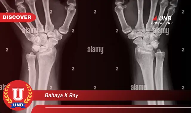bahaya x ray bahaya x ray