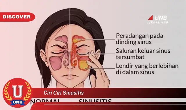 ciri ciri sinusitis