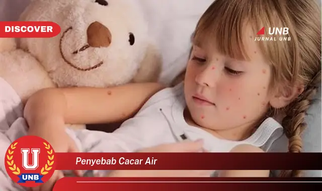 penyebab cacar air