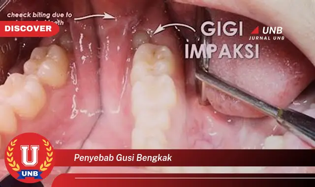 penyebab gusi bengkak