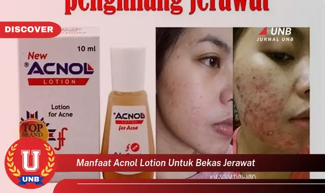 manfaat acnol lotion untuk bekas jerawat